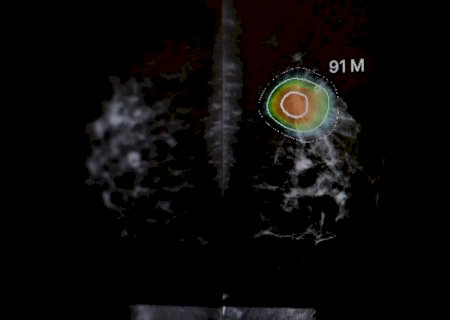 Mamografia com IA melhora diagnóstico de câncer, mostra estudo