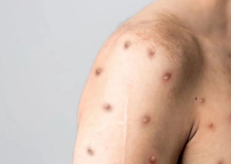 Mpox pode matar? Entenda riscos e letalidade da doença viral