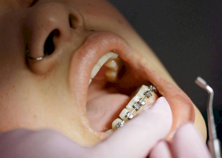 Por que os dentes voltam a entortar após o uso de aparelho ortodôntico