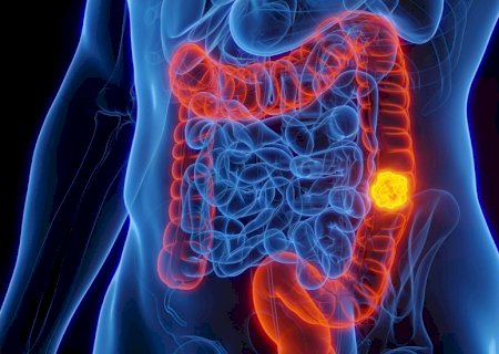 Câncer colorretal: os números não mentem (e o que você pode fazer agora)